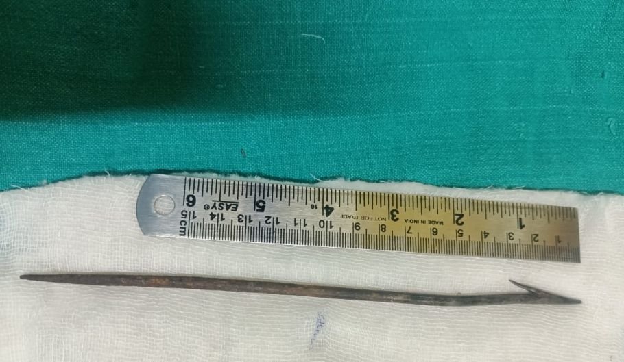 रायपुर में की दुर्लभ सर्जरी, 14 वर्षीय बालक के गले में धंसे 17.5 सेमी लंबे लोहे के औजार को सफलतापूर्वक निकाला 3 Screenshot 2025 07 17 7