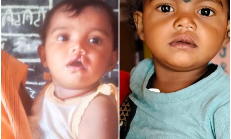 सरकारी मदद से बदली नन्ही रंजना की जिंदगी, कटे होंठ का सफल ऑपरेशन बना उम्मीद की मुस्कान 1 Government aid transforms little Ranjana's life; a successful cleft lip operation brings hope.