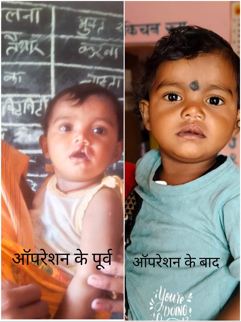 Government aid transforms little Ranjana's life; a successful cleft lip operation brings hope.