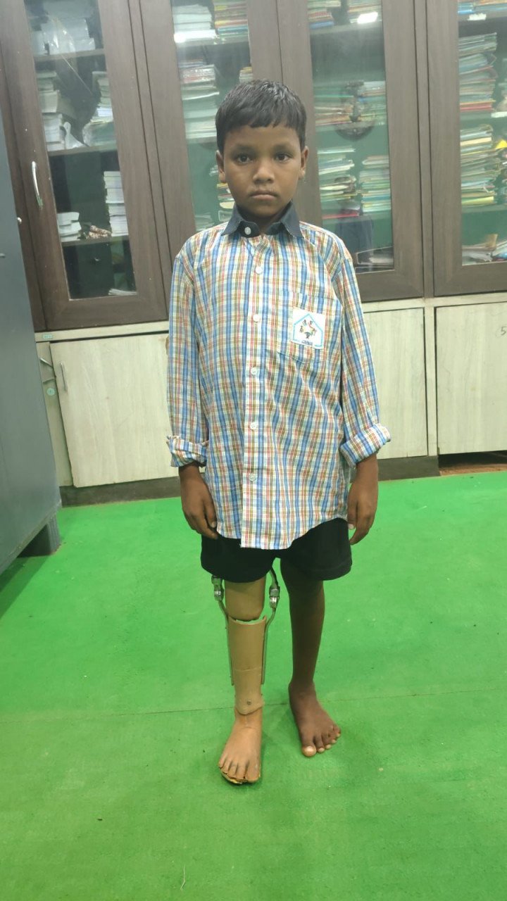 Prosthetic leg gives new strides to Kamlesh's dreams; Chirayu program transforms 10-year-old boy's life.