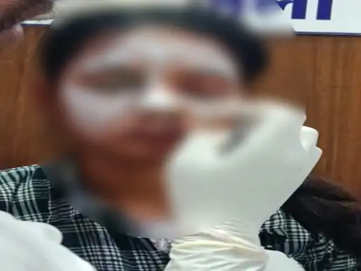 balod-acid-attack-on-college-girl-chhattisgarh